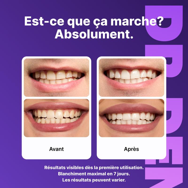 Bandes Blanchissantes Violettes – Sourire Visiblement Plus Blanc en 30 Minutes